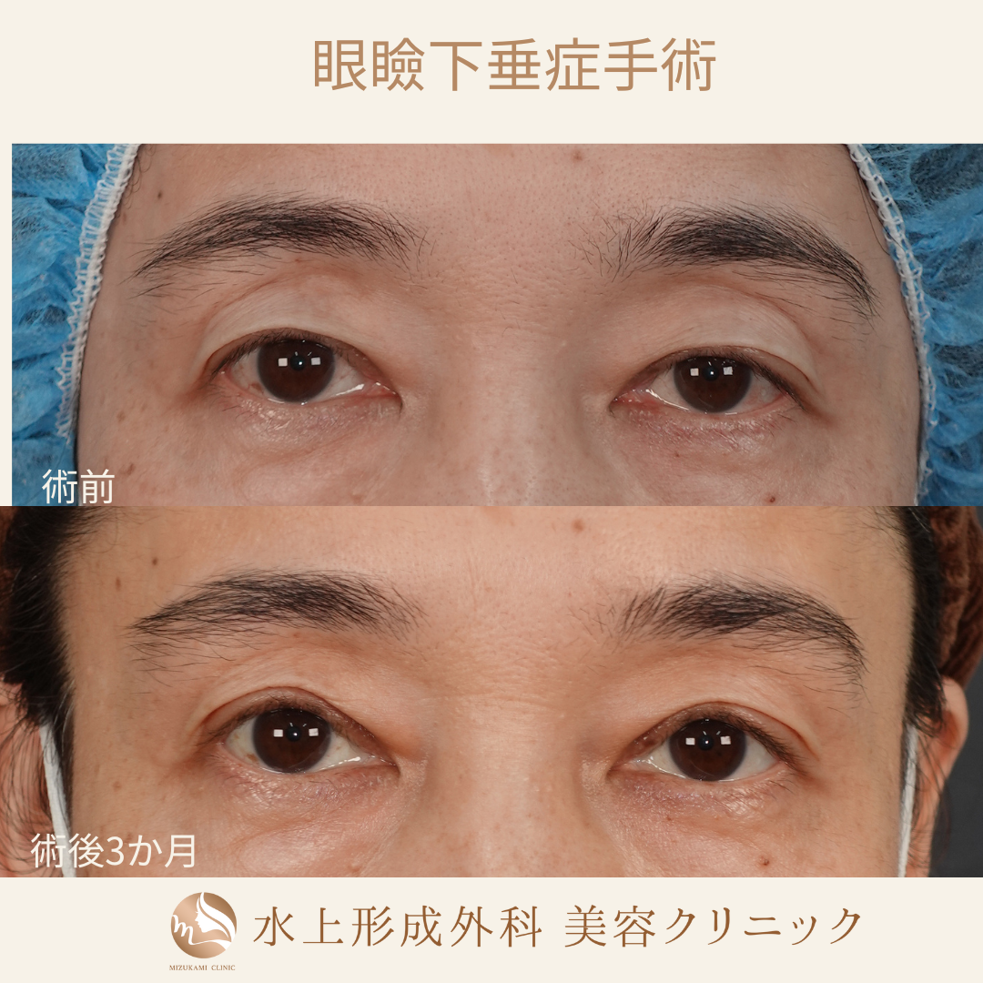 眼瞼下垂症手術
