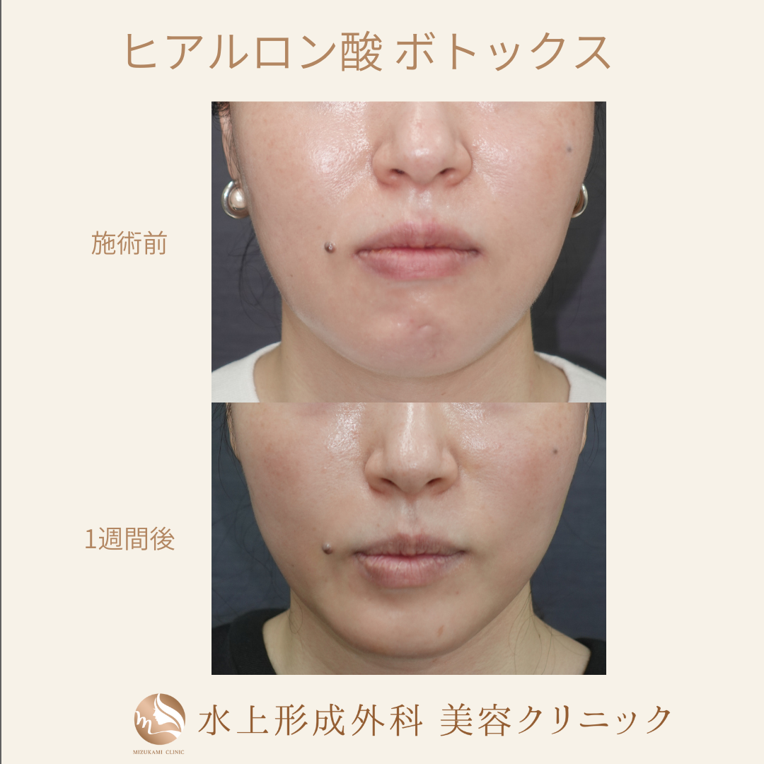 ヒアルロン酸 ボトックスの症例写真3