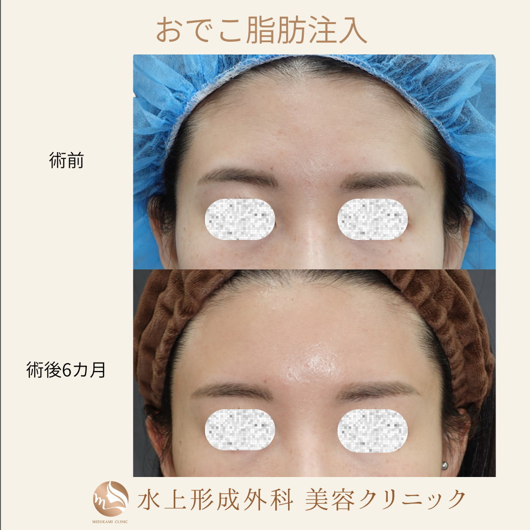 脂肪注入(前額、眉間、こめかみ)