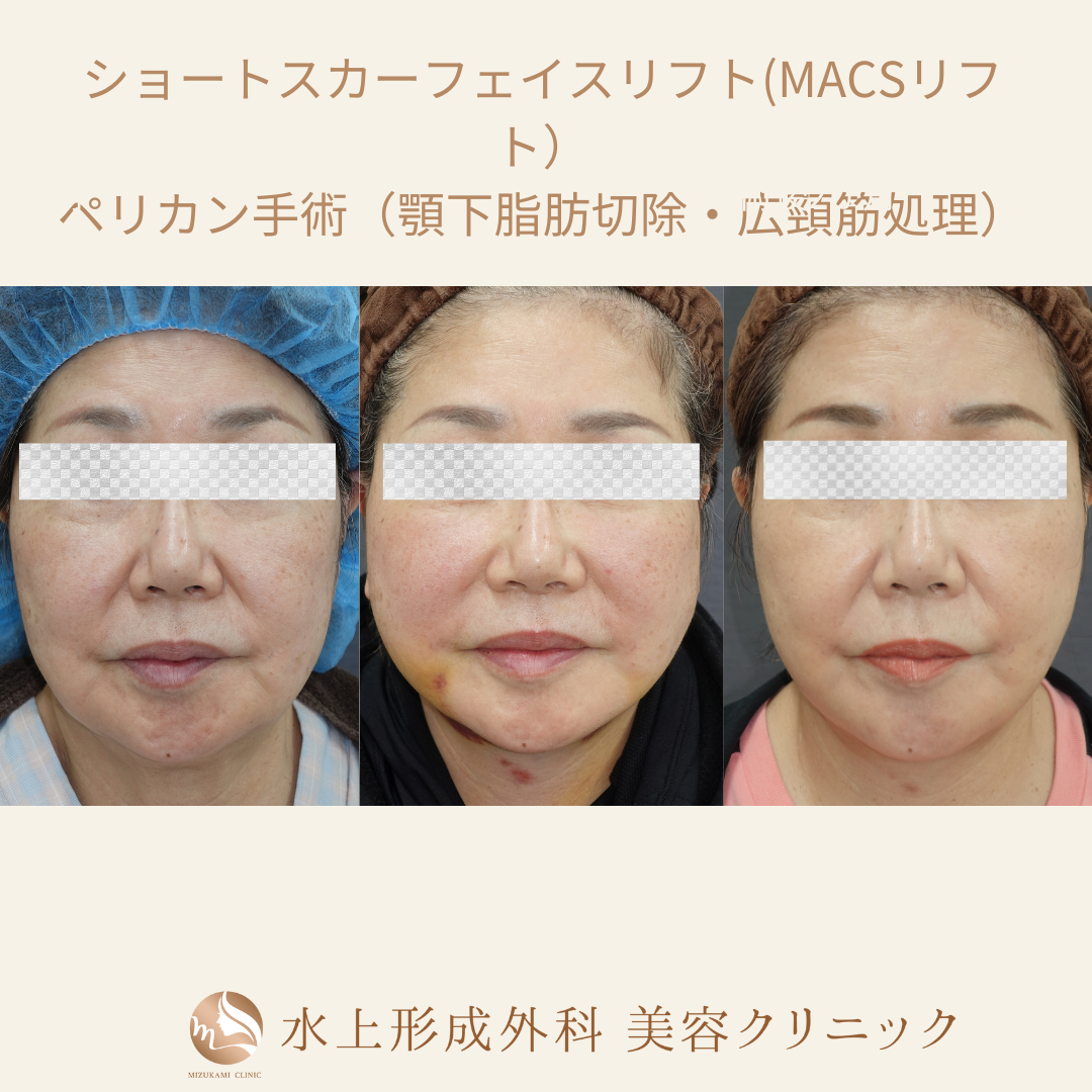 ショートスカーフェイスリフト・ペリカン手術の症例写真3