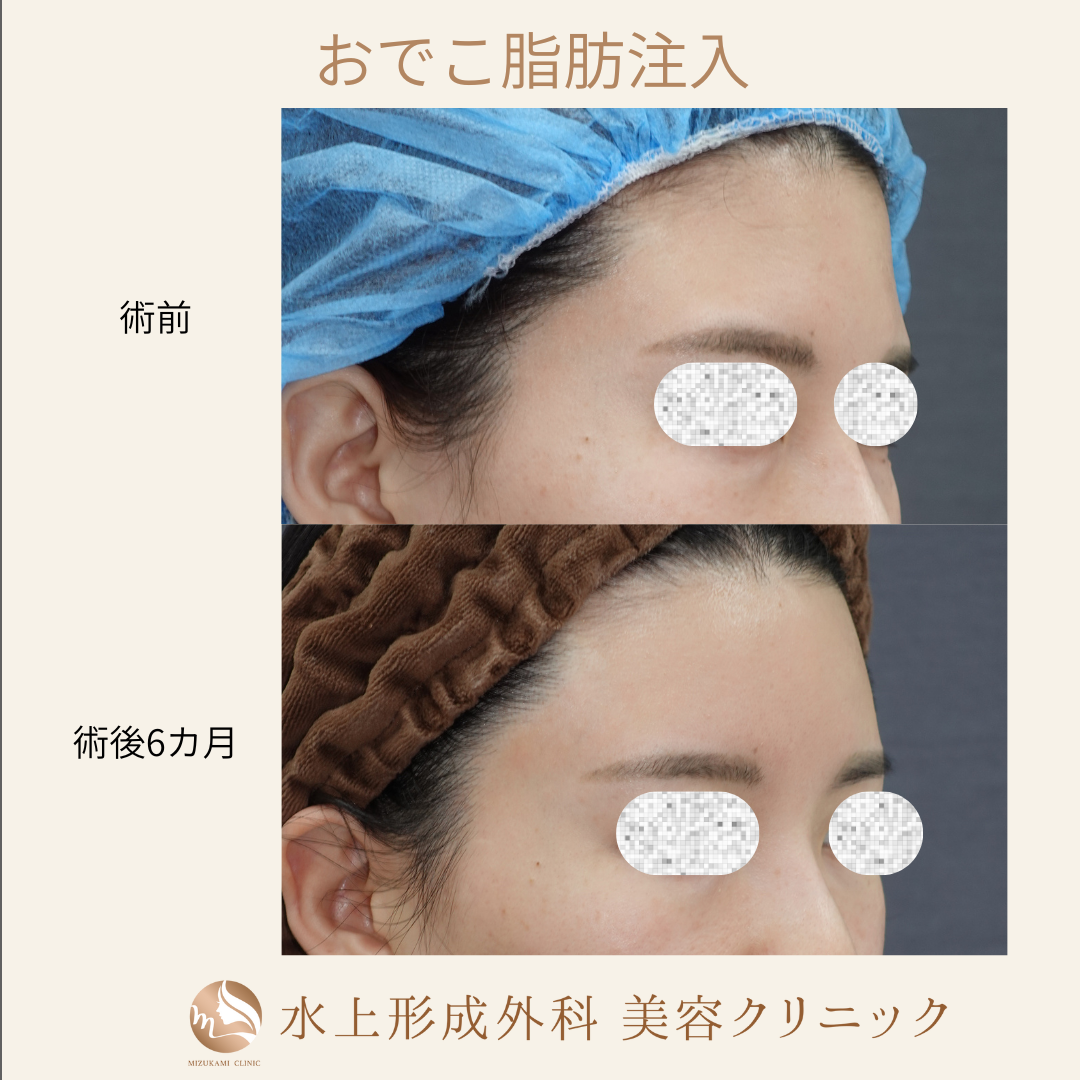 脂肪注入(前額、眉間、こめかみ)の症例写真3