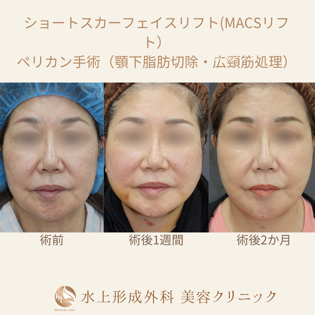 ショートスカーフェイスリフト・ペリカン手術の症例写真3