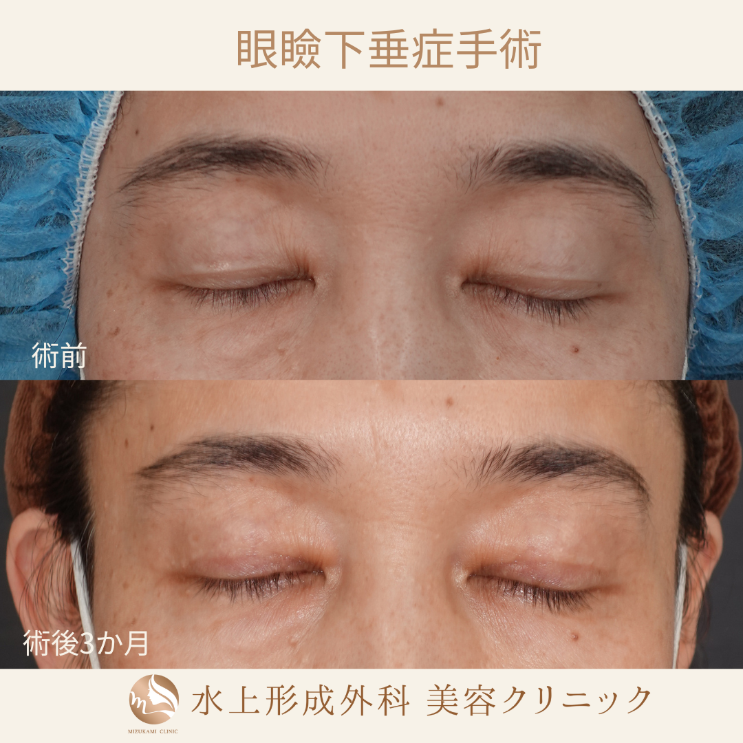 眼瞼下垂症手術の症例写真2