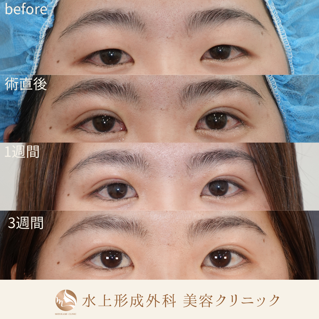 二重埋没法の症例写真4