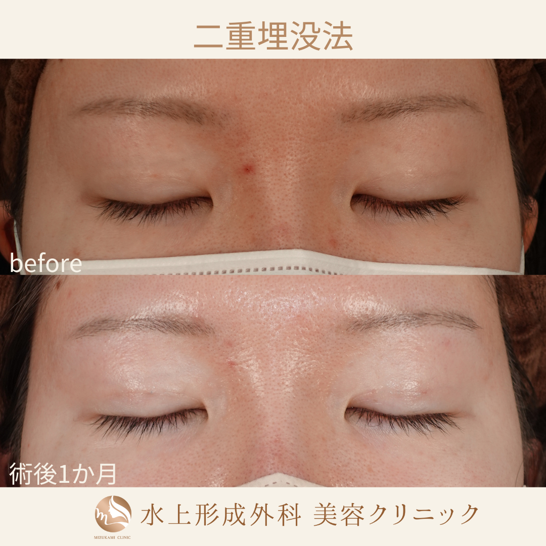 二重埋没法の症例写真2