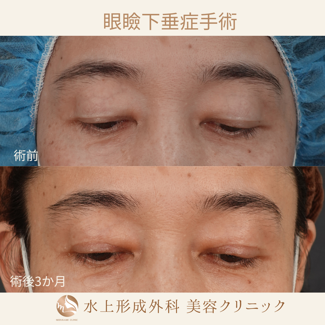 眼瞼下垂症手術の症例写真3