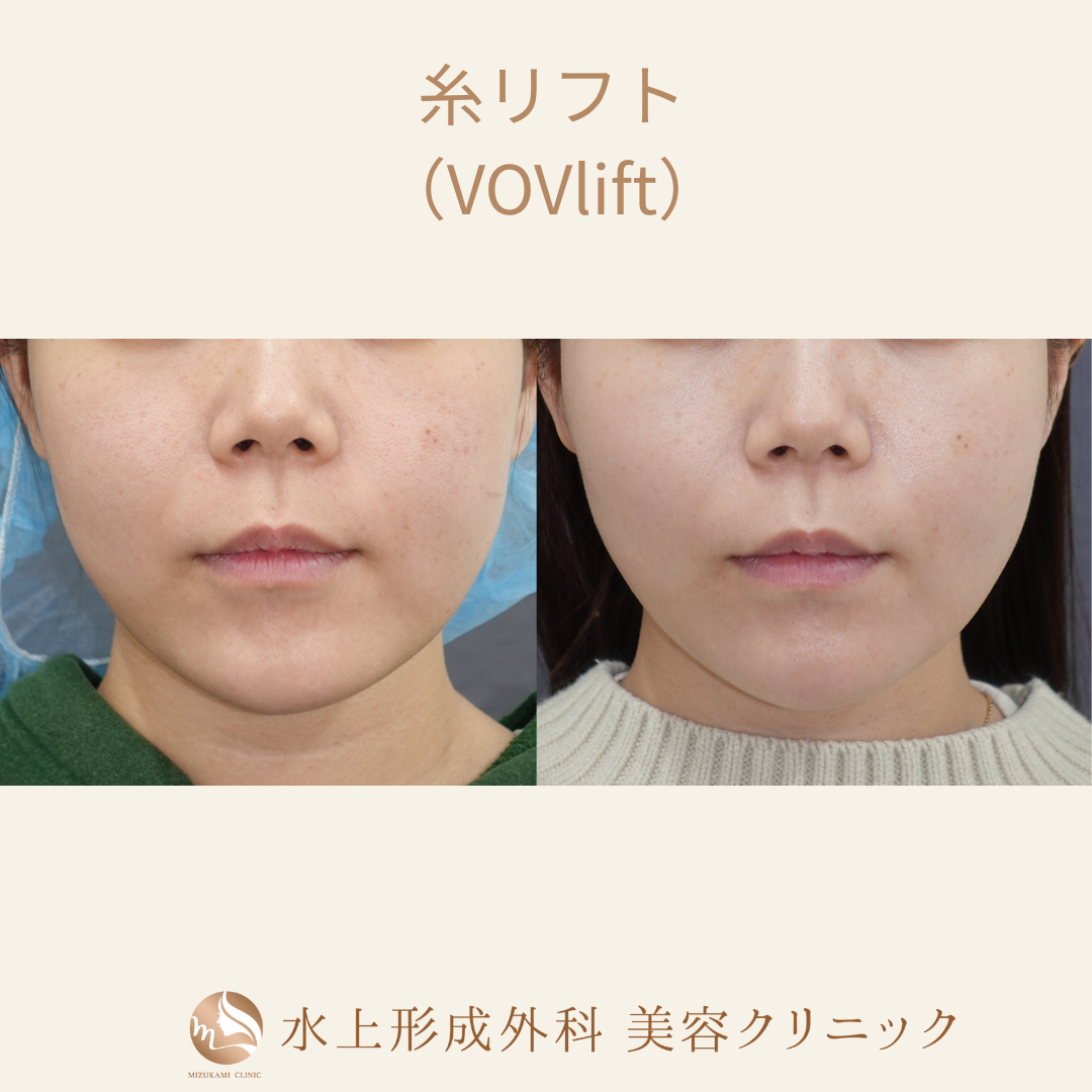 糸リフトの症例写真2