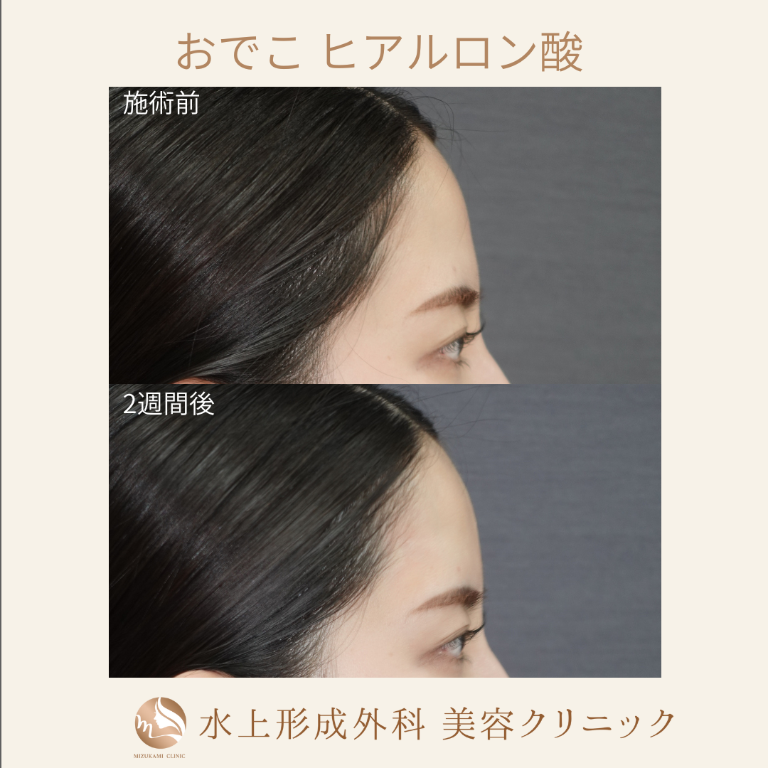 おでこ ヒアルロン酸