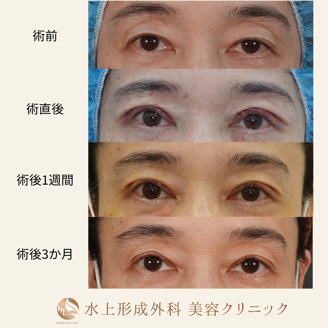 眼瞼下垂症手術の症例写真4