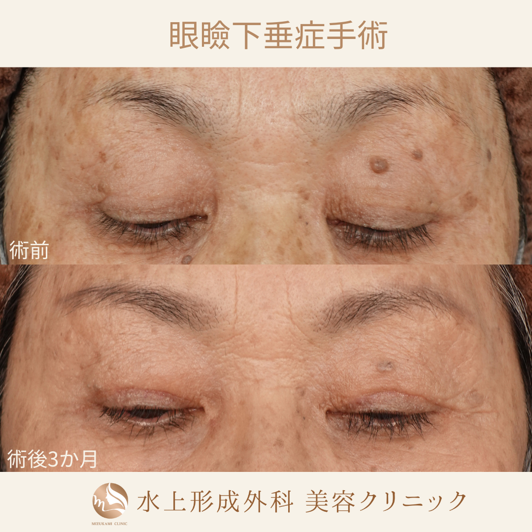 眼瞼下垂症手術の症例写真3