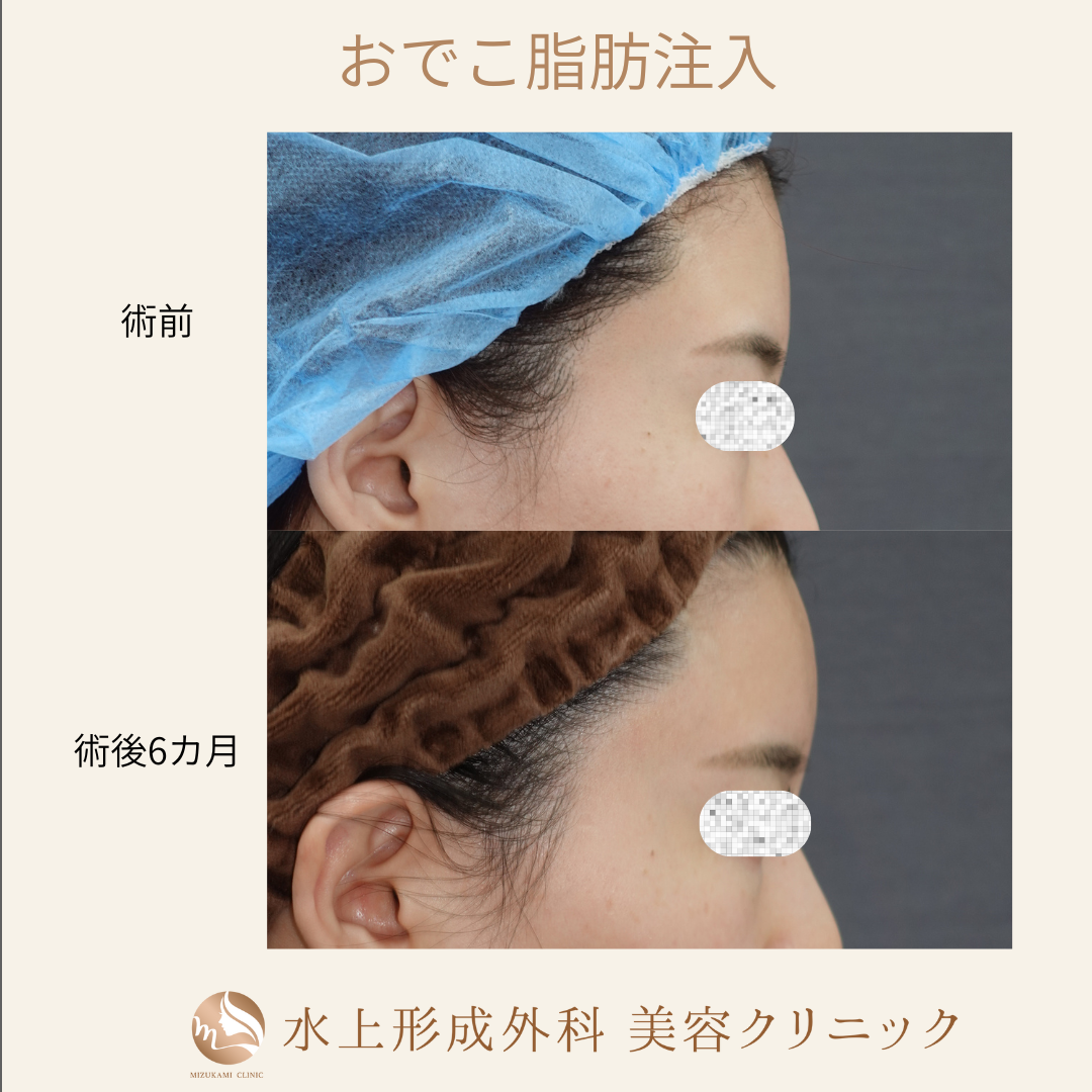 脂肪注入(前額、眉間、こめかみ)の症例写真4