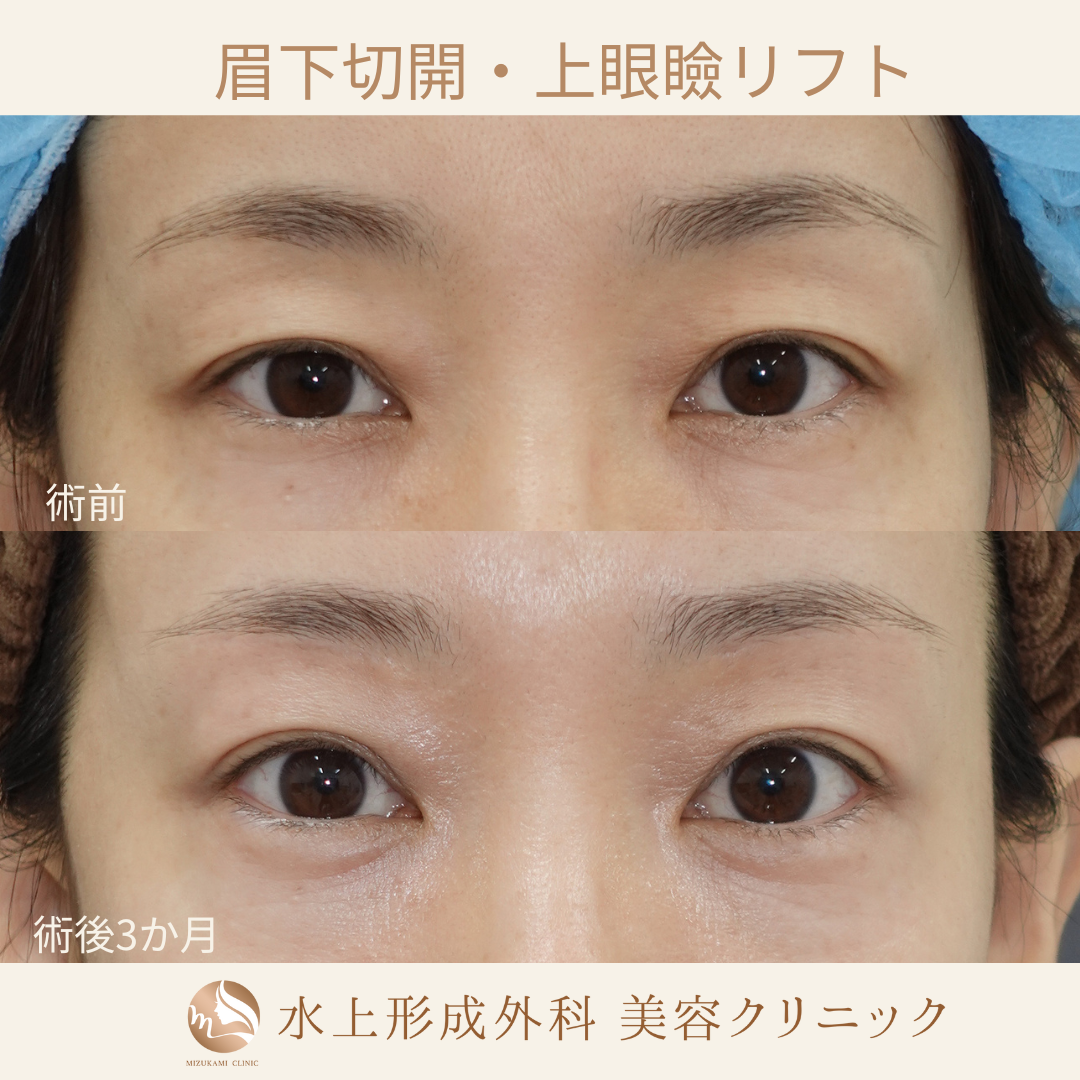 眉下切開・上眼瞼リフト