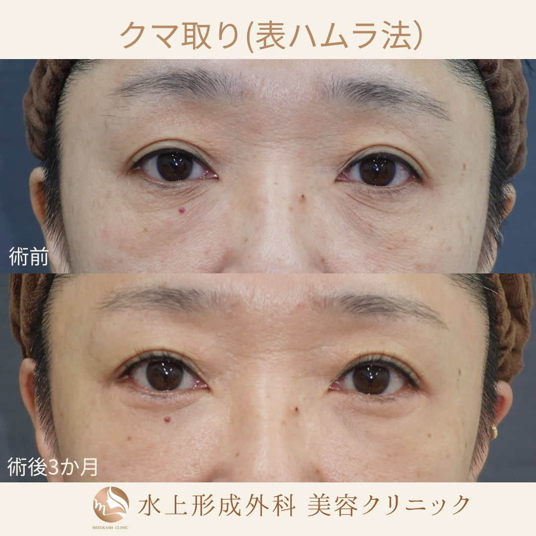 クマ取り(表ハムラ法)