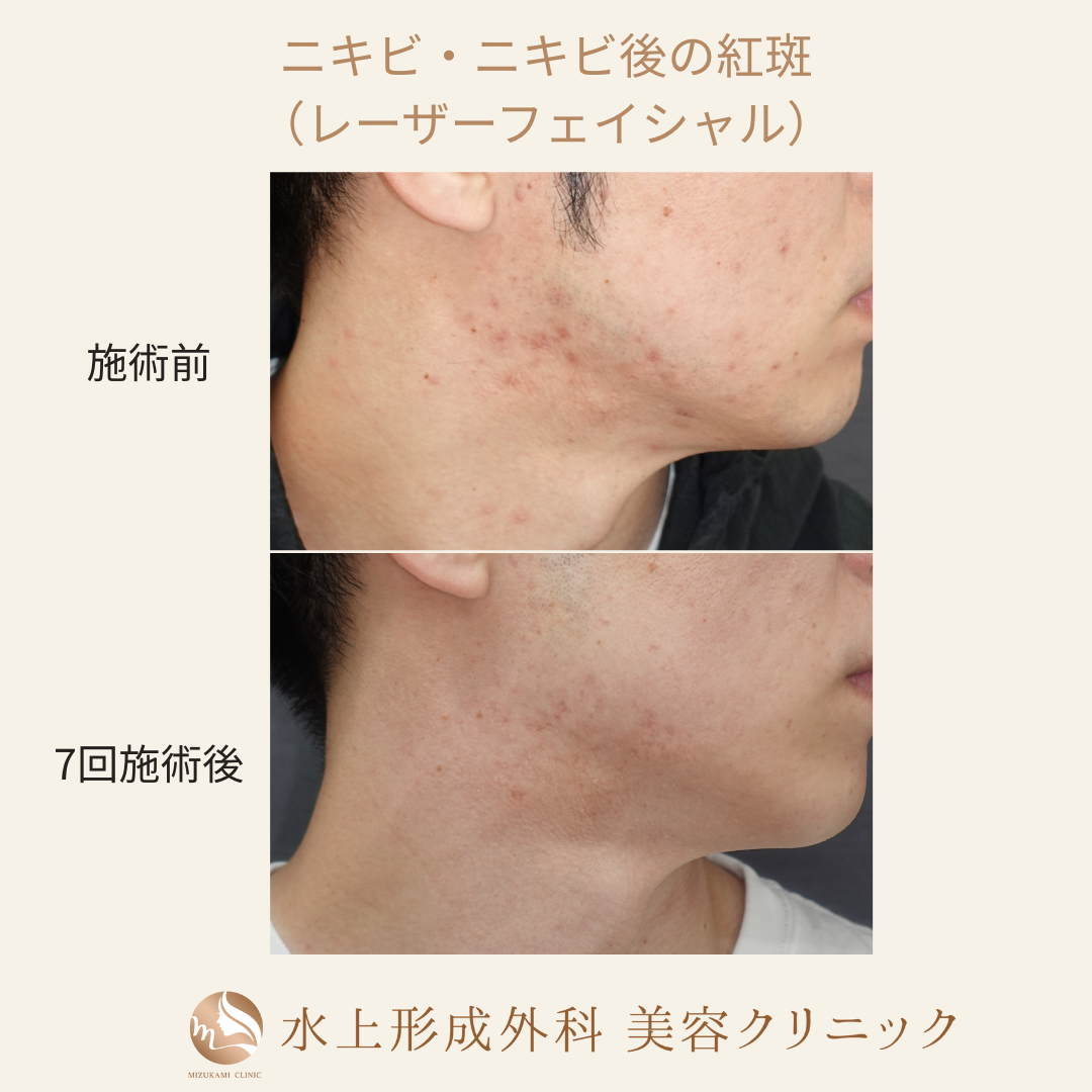 ニキビ(レーザーフェイシャル カスタマイズ)
