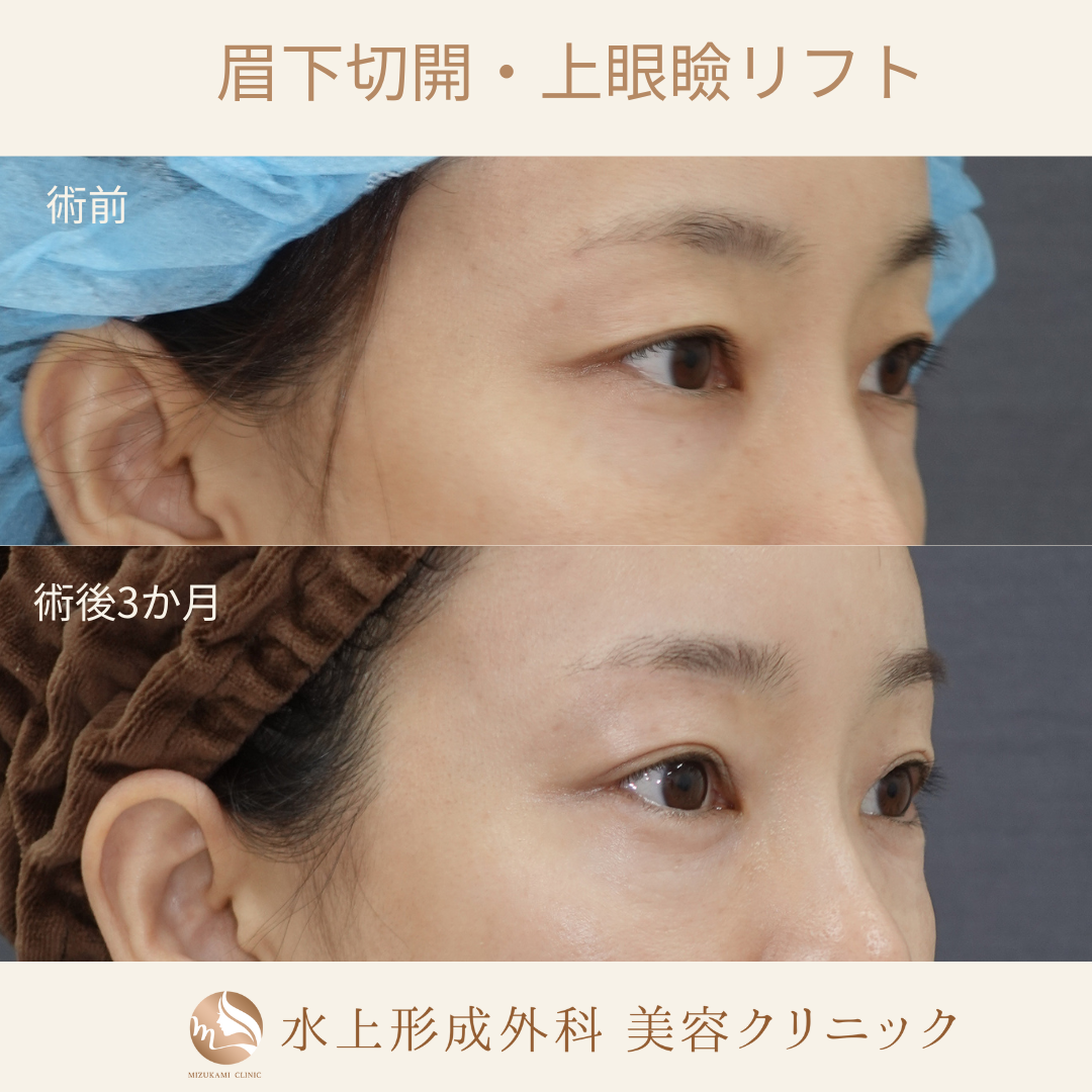 眉下切開・上眼瞼リフトの症例写真2