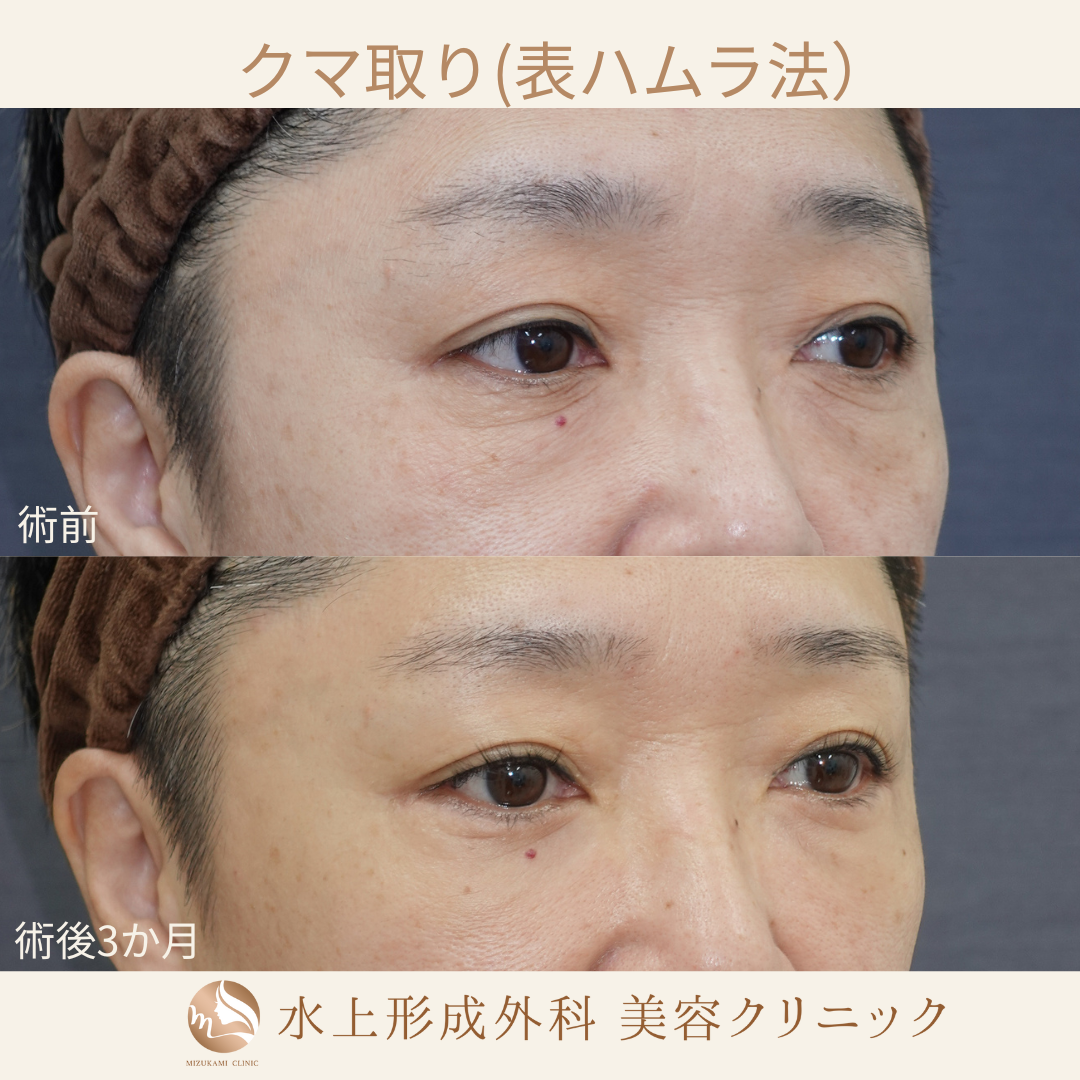 クマ取り(表ハムラ法)の症例写真2