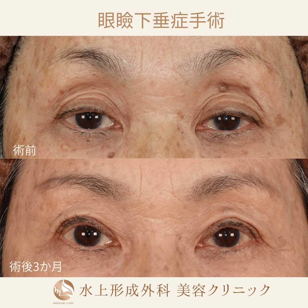 眼瞼下垂症手術