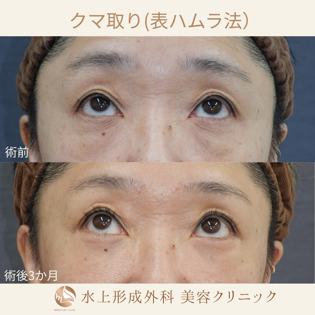 クマ取り(表ハムラ法)の症例写真3