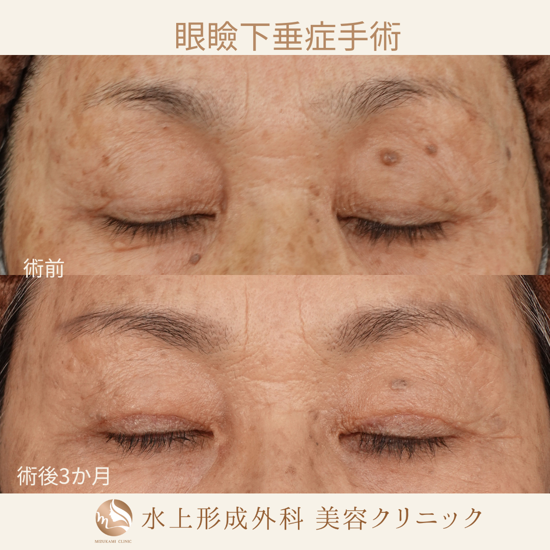 眼瞼下垂症手術の症例写真2