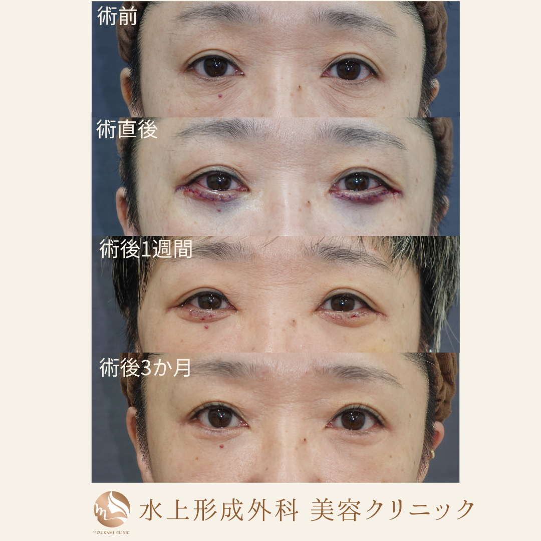 クマ取り(表ハムラ法)の症例写真4