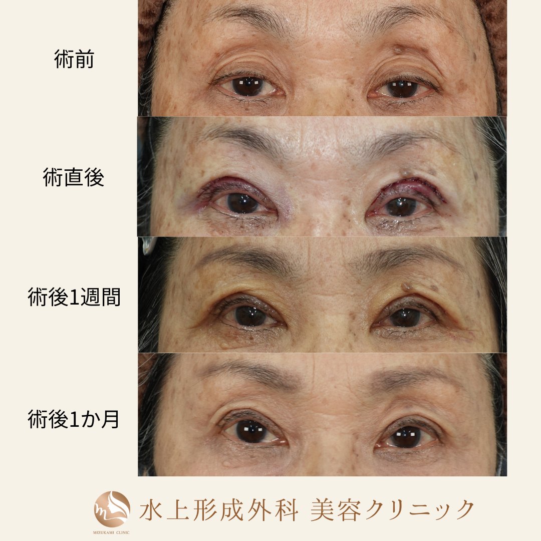 眼瞼下垂症手術の症例写真4