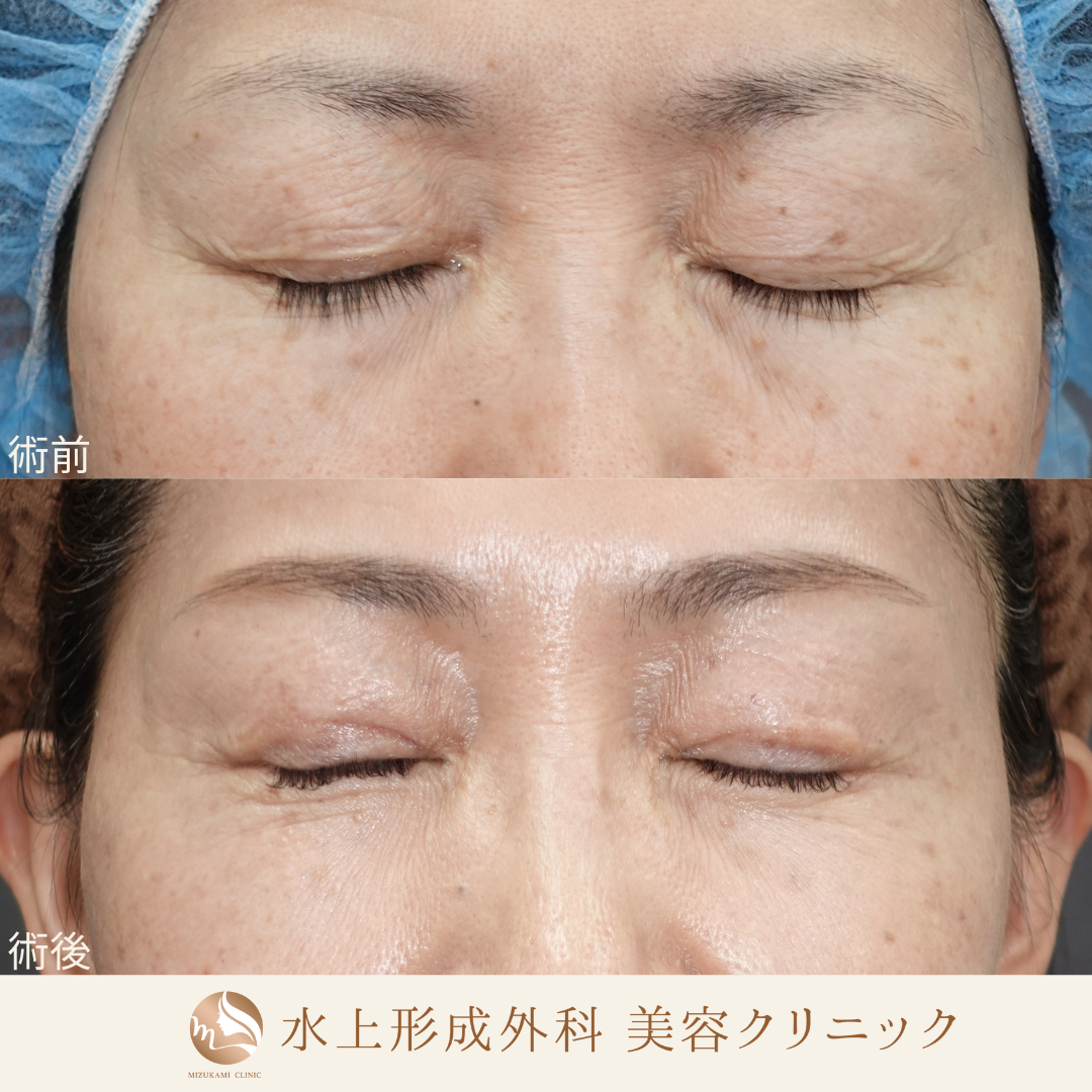 眼瞼下垂症手術、クマ取り（表ハムラ）の症例写真2