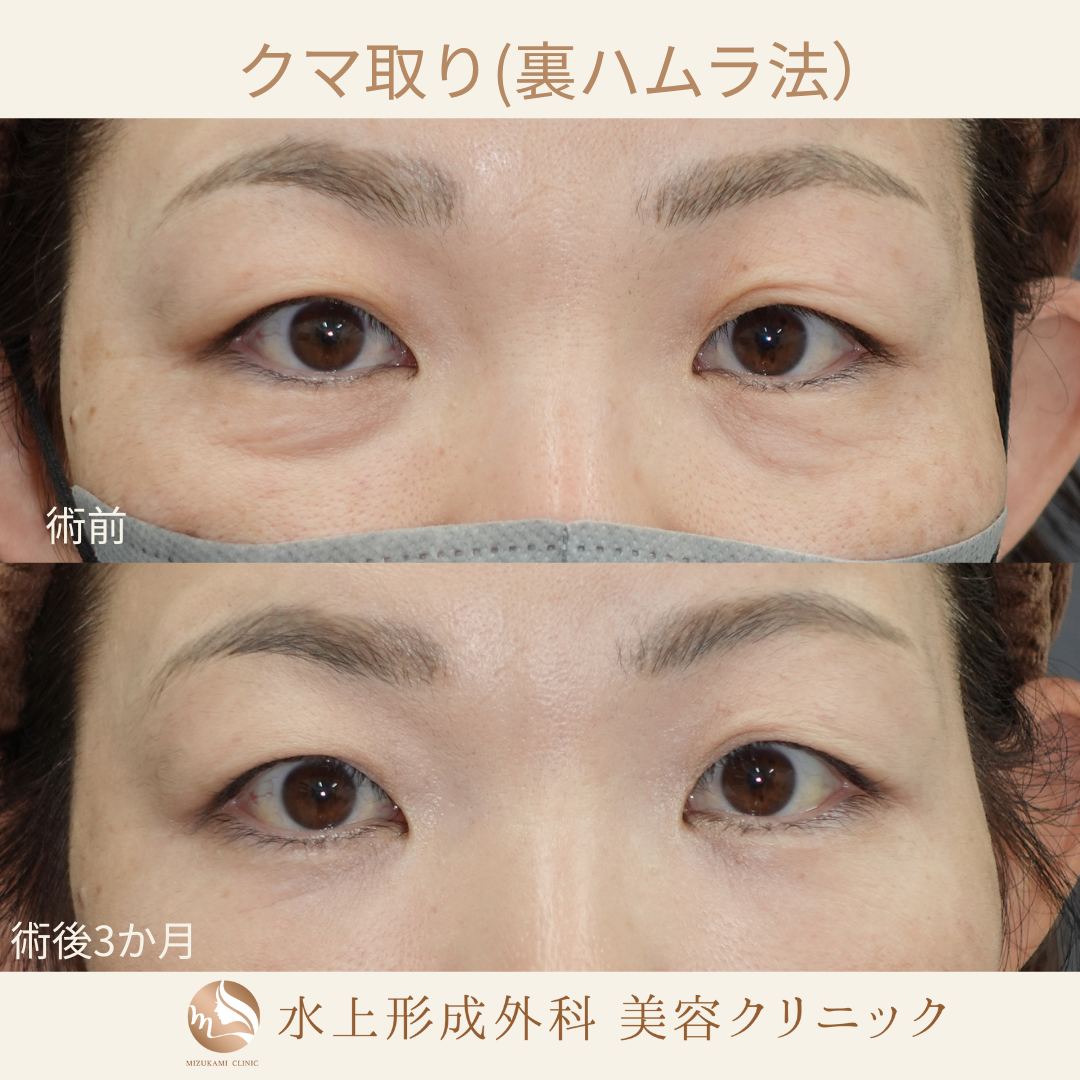 クマ取り（裏ハムラ）