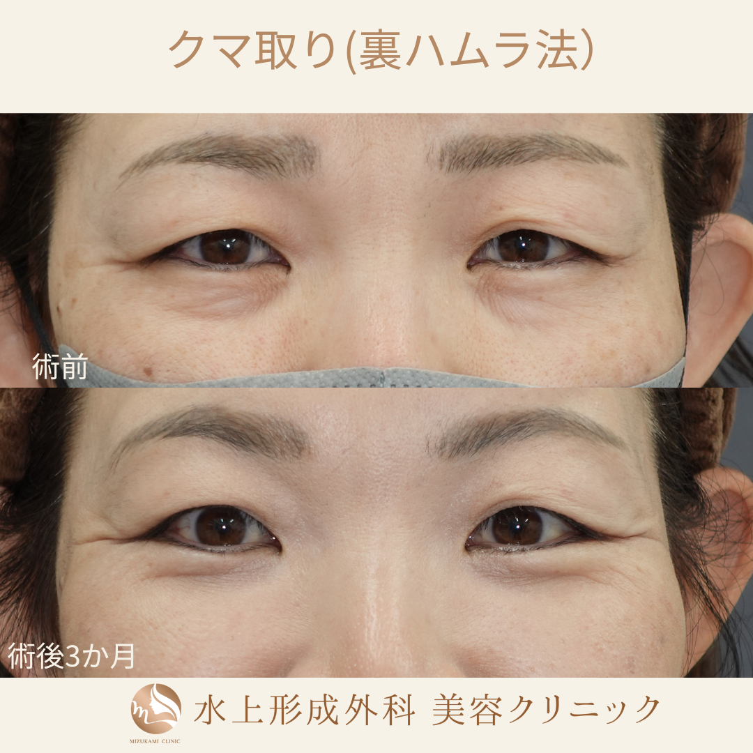 クマ取り（裏ハムラ）の症例写真2