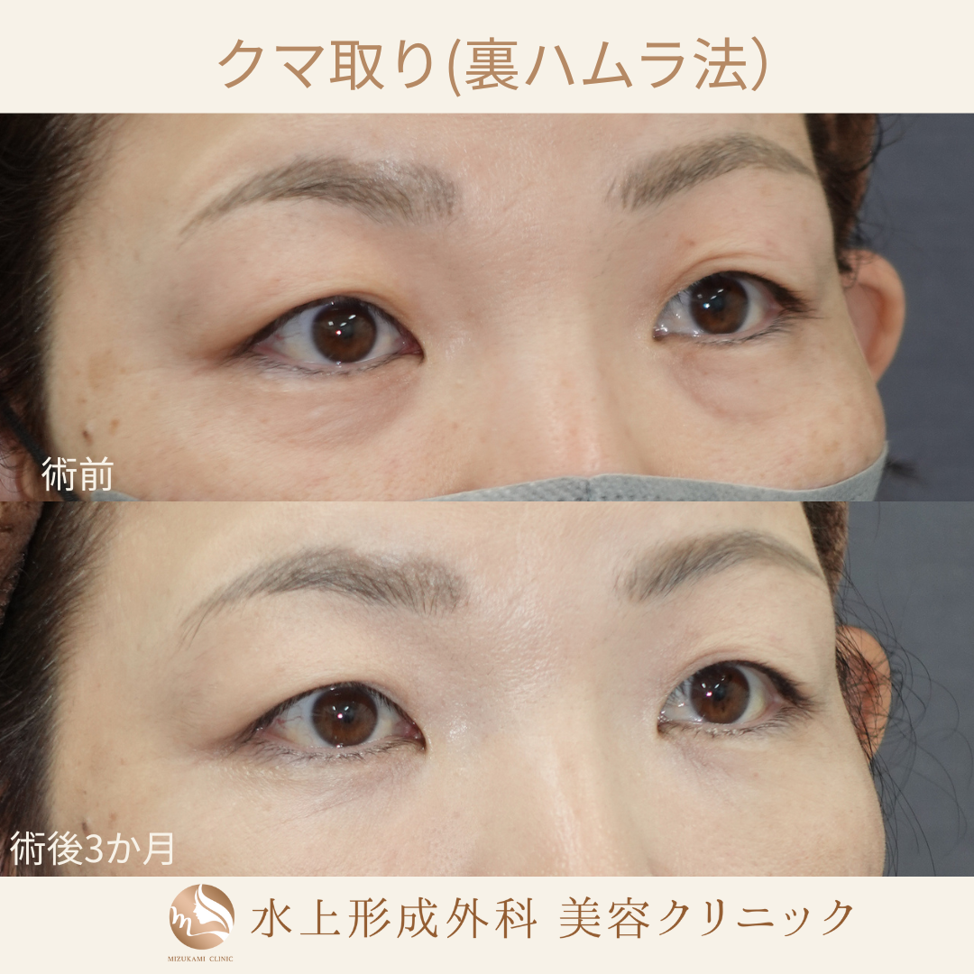 クマ取り（裏ハムラ）の症例写真3