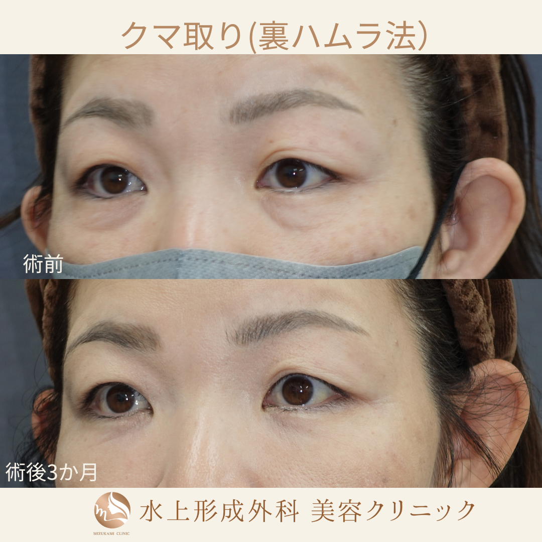 クマ取り（裏ハムラ）の症例写真4