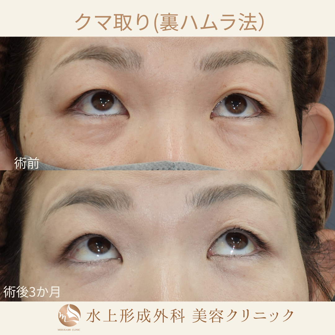 クマ取り（裏ハムラ）の症例写真5