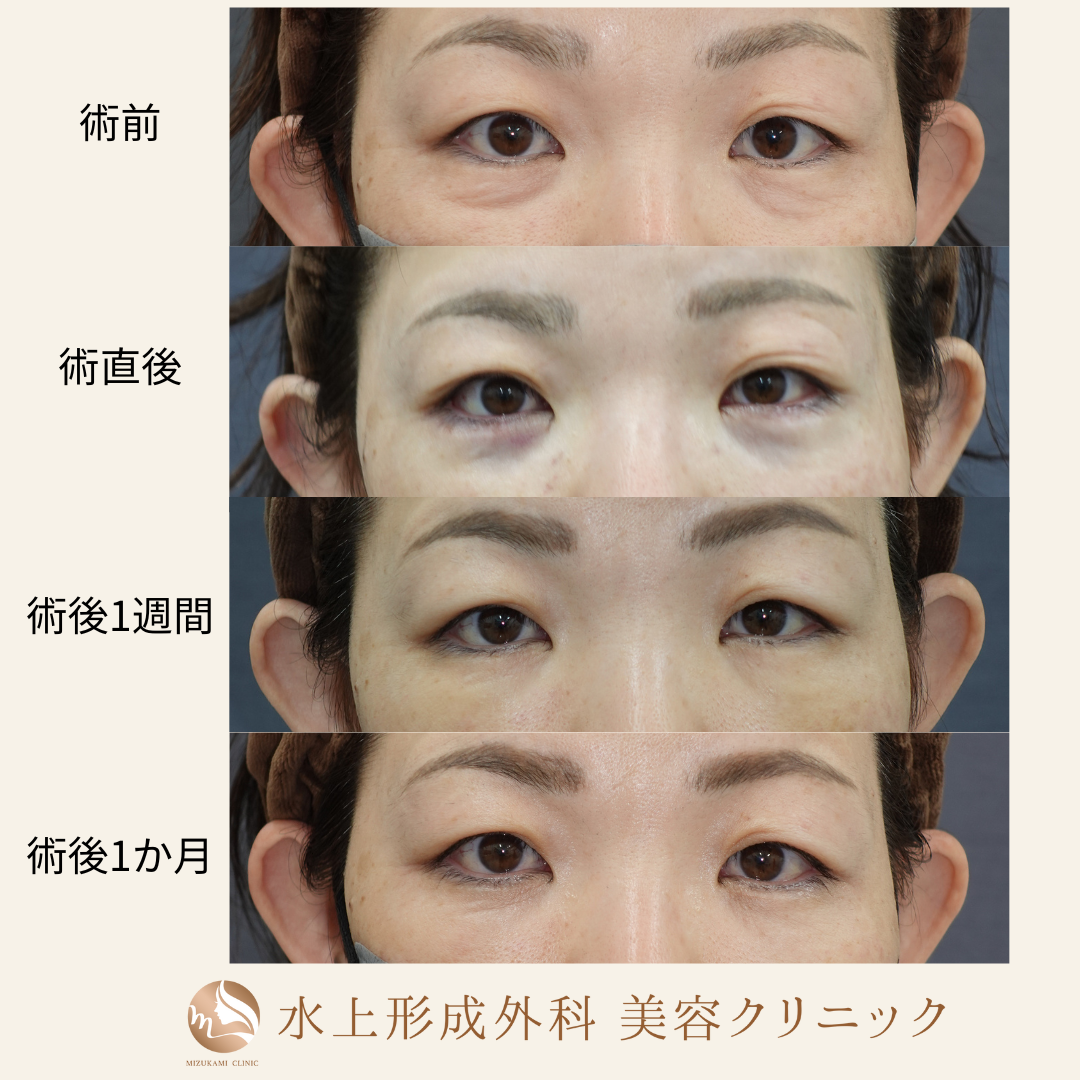 クマ取り（裏ハムラ）の症例写真6