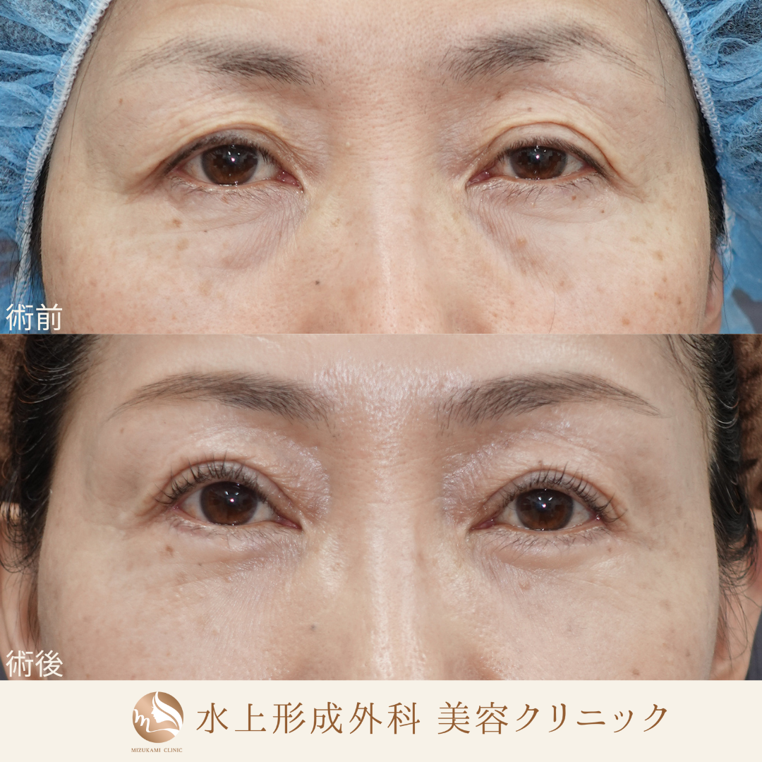 眼瞼下垂症手術、クマ取り（表ハムラ）