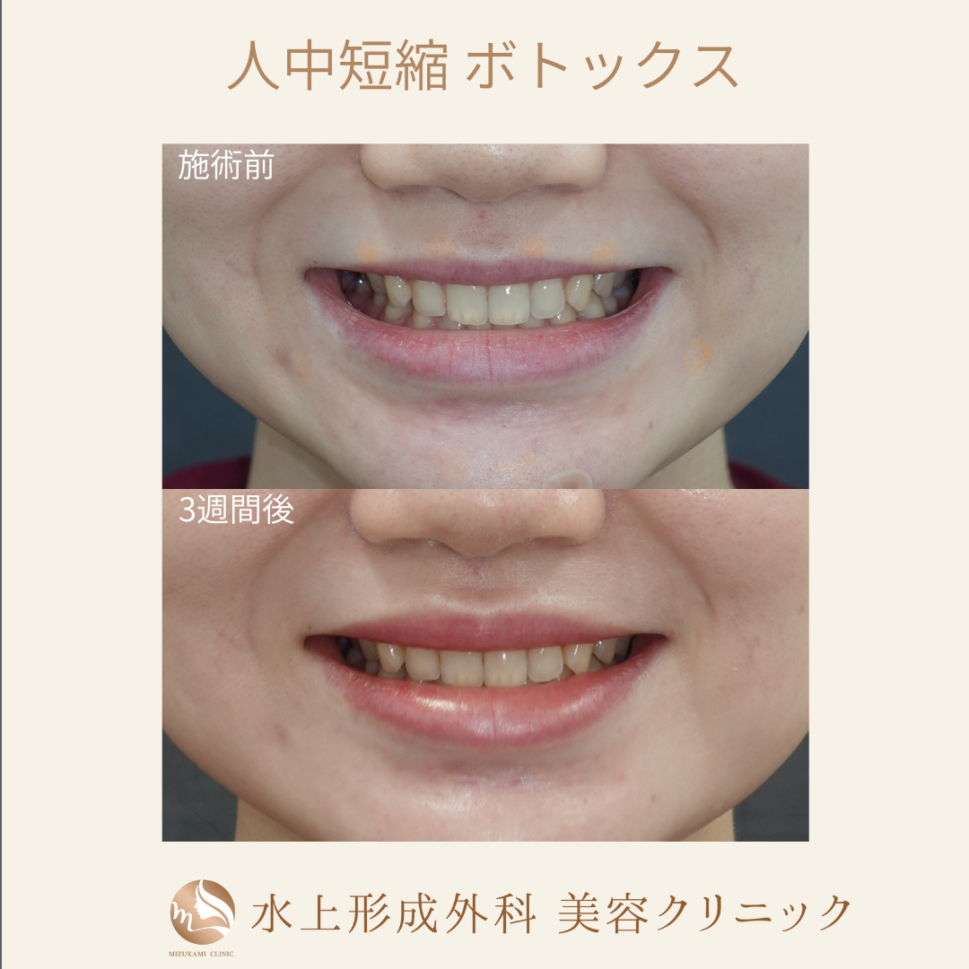 人中短縮 ボトックス