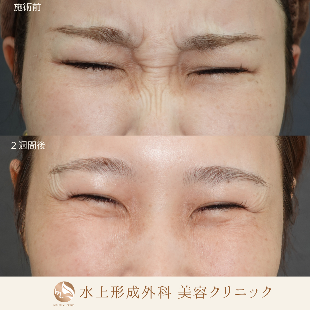 バニーライン ボトックス