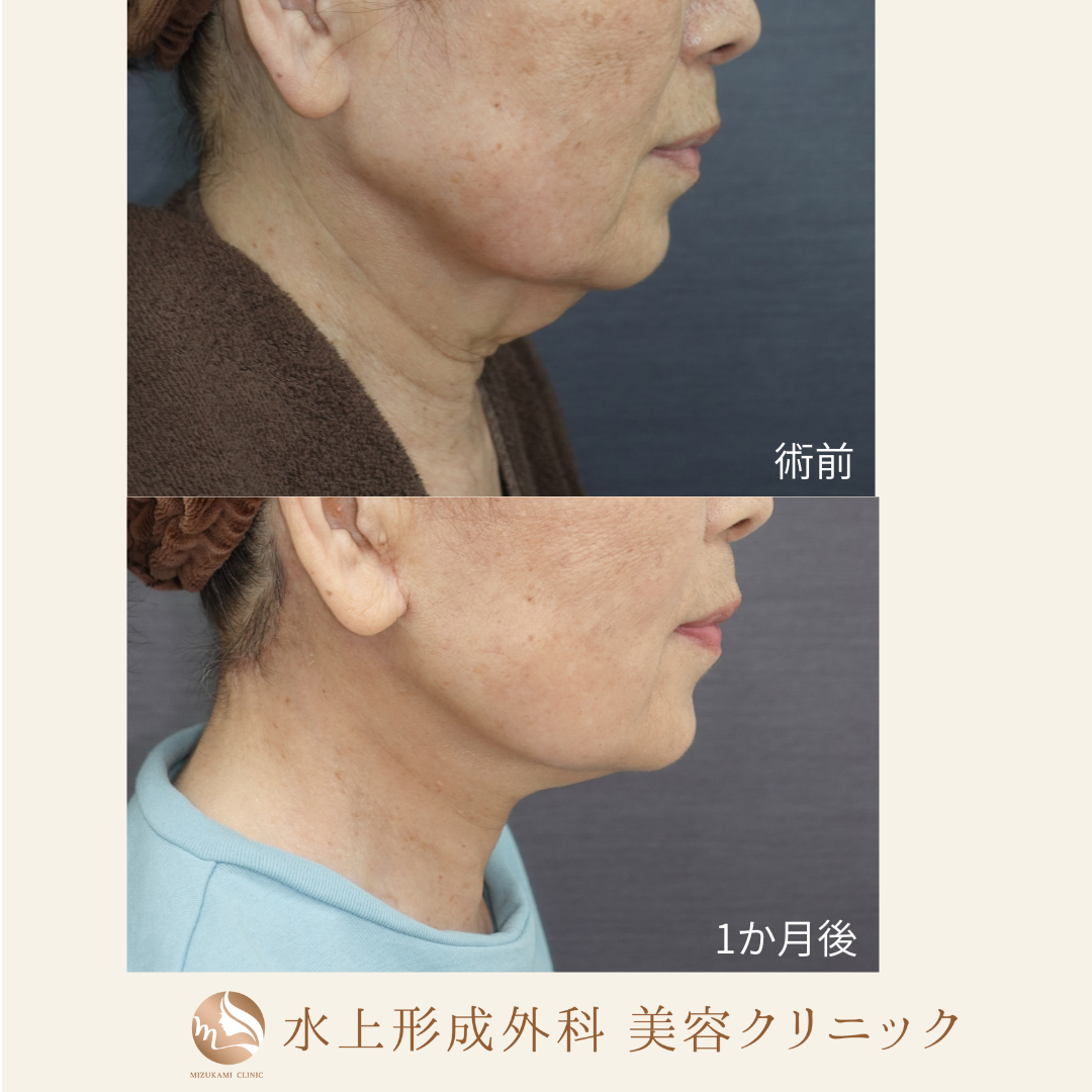 ネックリフトの症例写真2