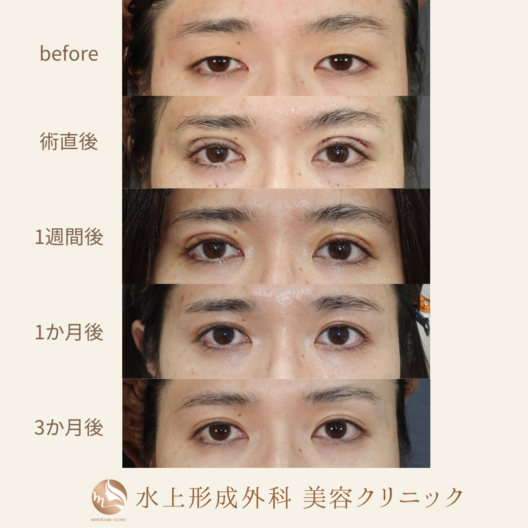 二重全切開法の症例写真3