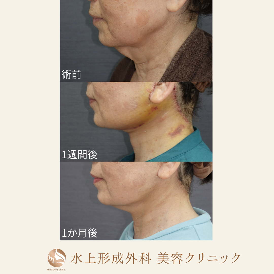 ネックリフトの症例写真3