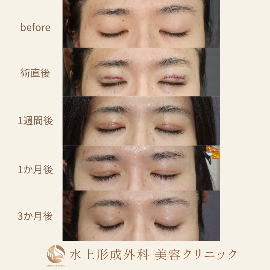 二重全切開法の症例写真4