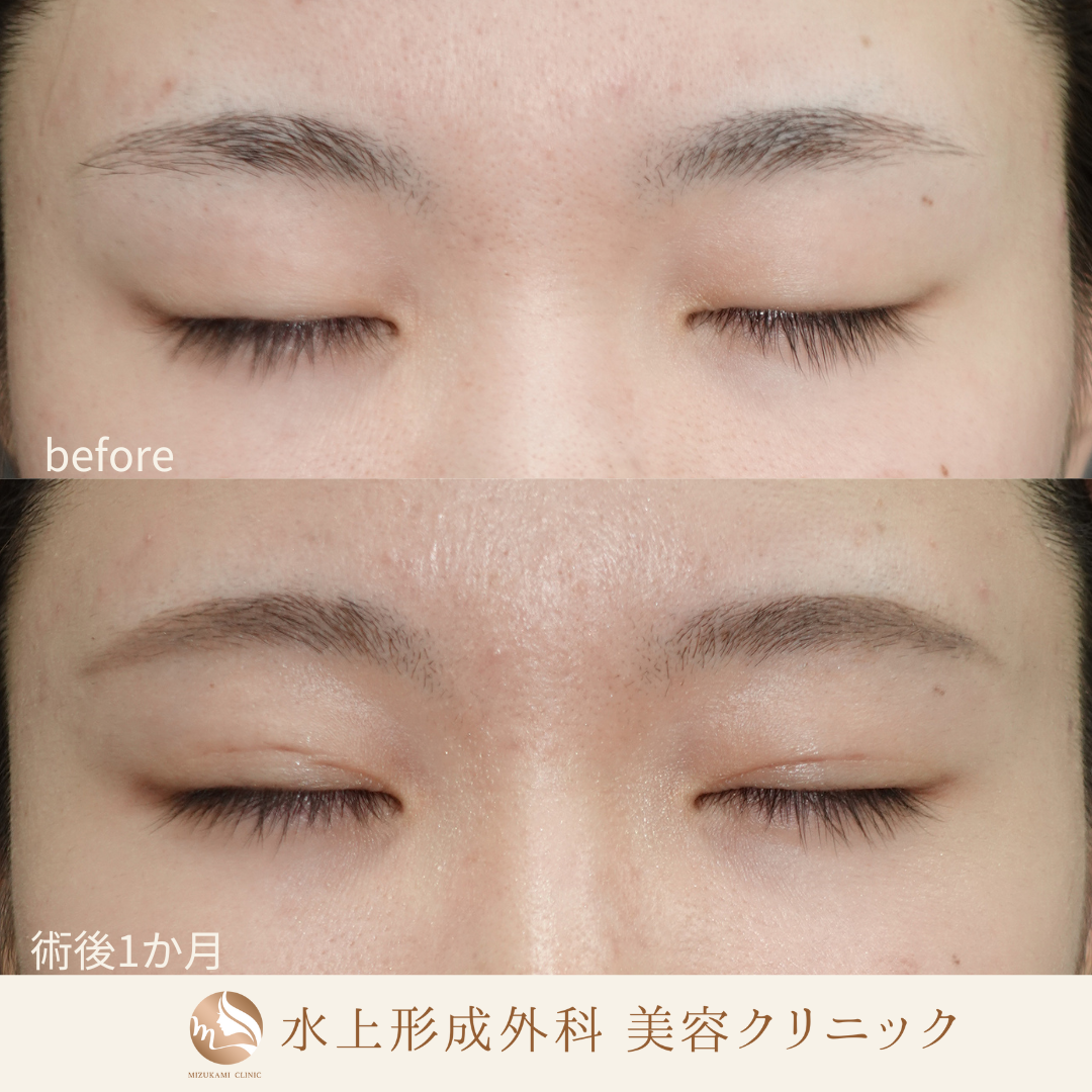 二重埋没法の症例写真2