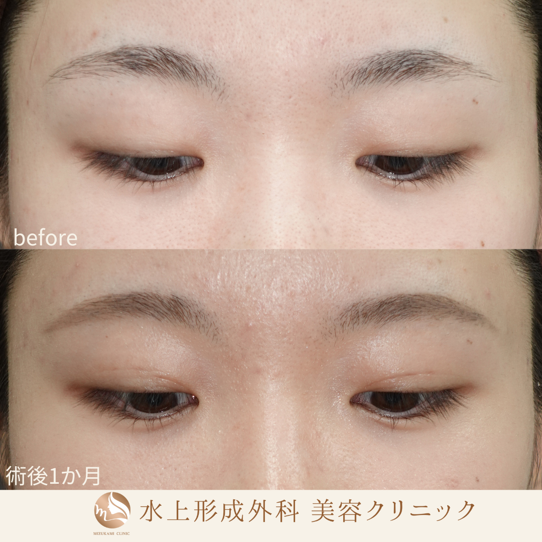 二重埋没法の症例写真3