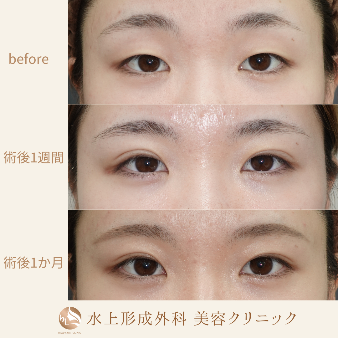 二重埋没法の症例写真4