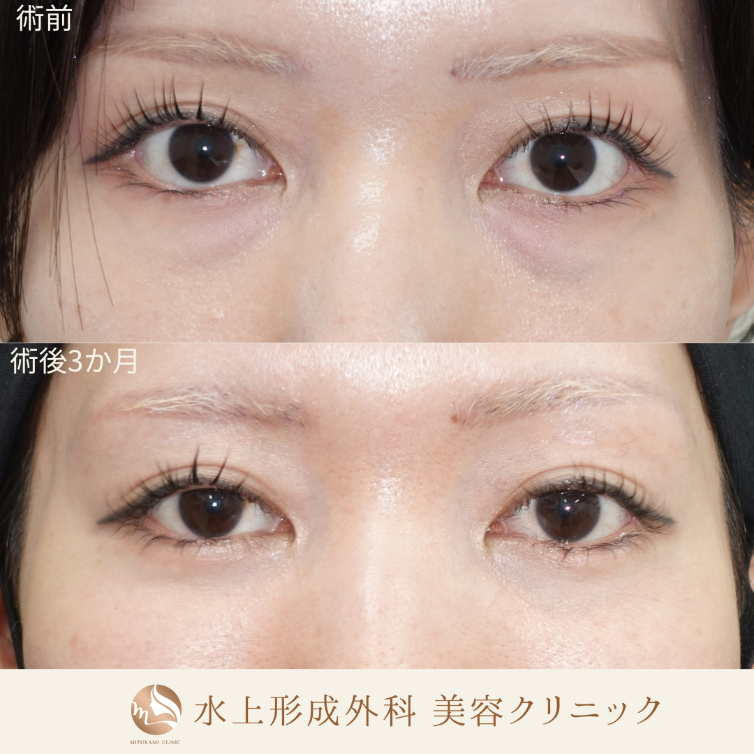 クマ取り（裏ハムラ）