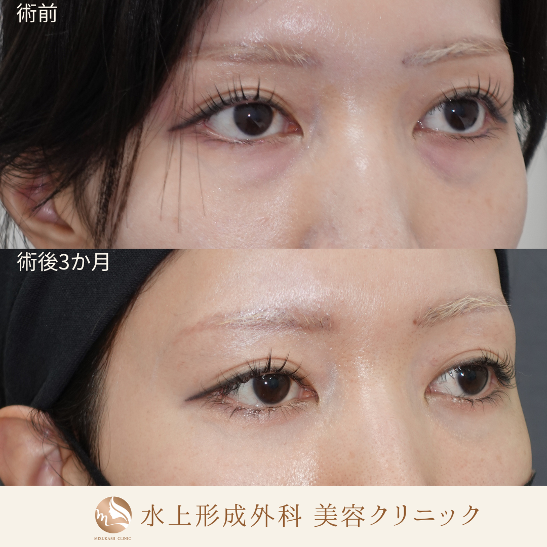 クマ取り（裏ハムラ）の症例写真2