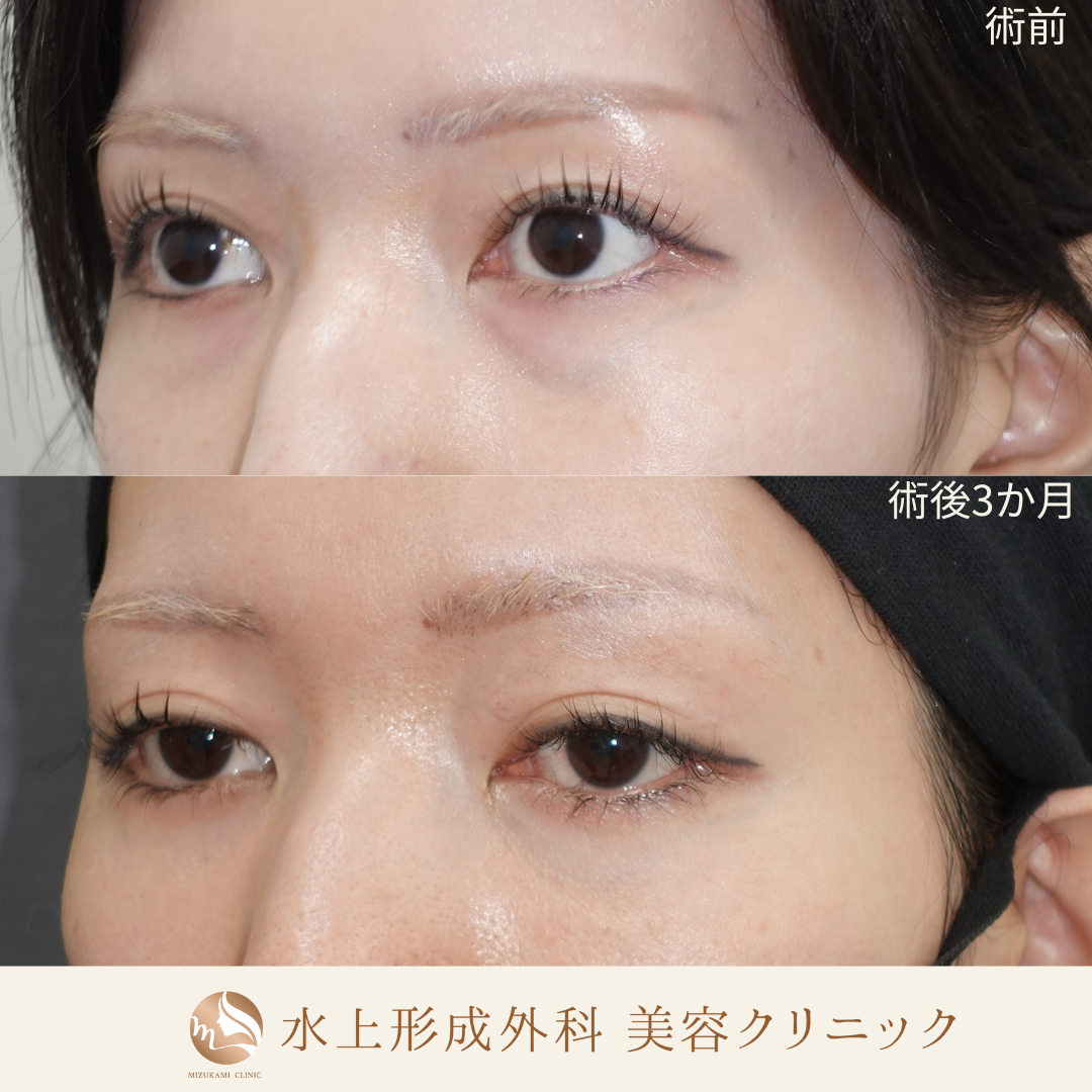 クマ取り（裏ハムラ）の症例写真3