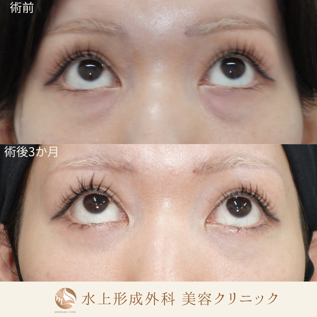 クマ取り（裏ハムラ）の症例写真4