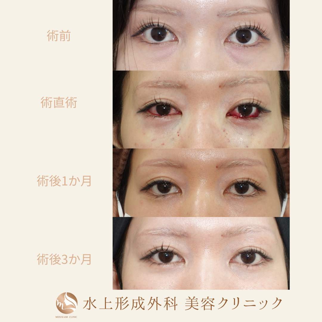 クマ取り（裏ハムラ）の症例写真5