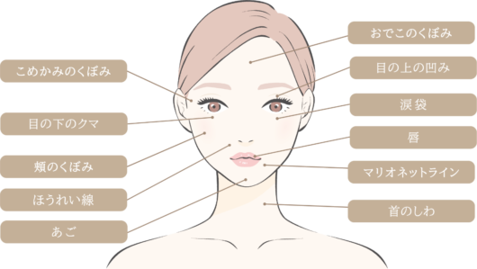 ヒアルロン酸注射の部位のイラスト