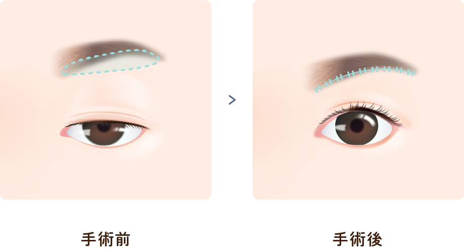 眉下切開・上眼瞼リフトの手術前と手術後のイラスト