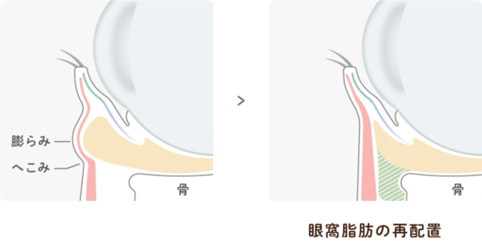 眼窩脂肪の再配置イラスト